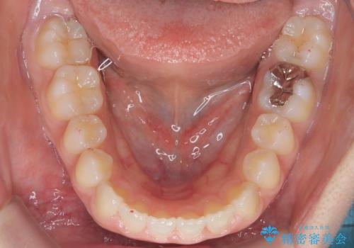 【インビザライン】前歯のすき間をなおしたい。の治療後