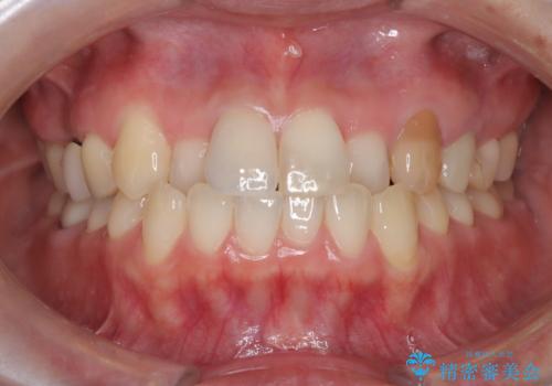 【オールセラミック】前歯の色を変えたい。の治療後