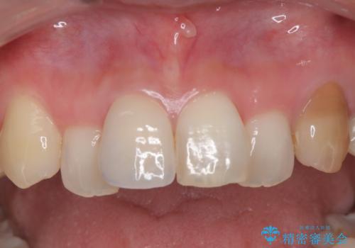 【オールセラミック】前歯の色を変えたい。の症例 治療後