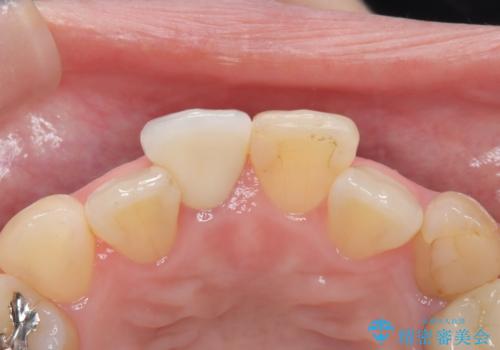 【オールセラミック】前歯の色を変えたい。の治療後