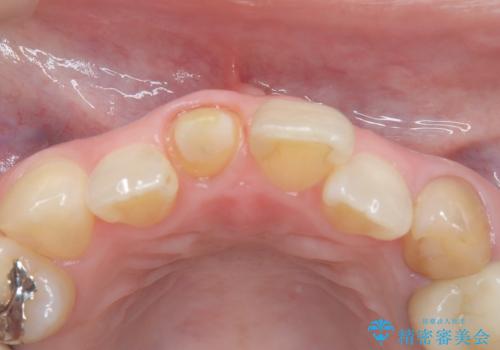 【オールセラミック】前歯の色を変えたい。の治療中