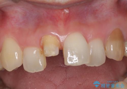 【オールセラミック】前歯の色を変えたい。の治療中