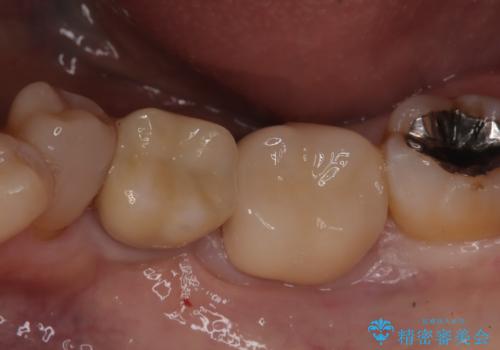 メタルインレーの下は。クラックラインを認めた歯。の治療後