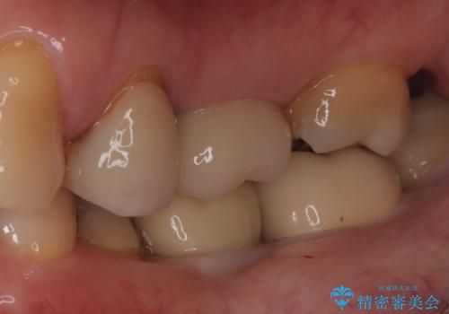 メタルインレーの下は。クラックラインを認めた歯。の治療後