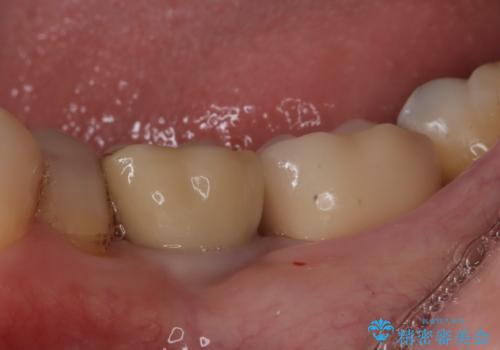 メタルインレーの下は。クラックラインを認めた歯。の治療後