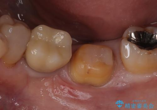 メタルインレーの下は。クラックラインを認めた歯。の治療中