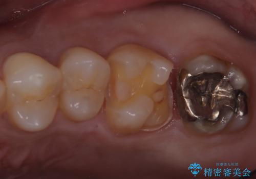 【セラミックインレー】歯科検診にて虫歯発見。の治療中