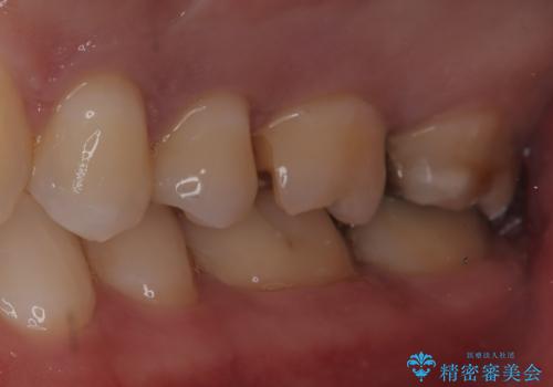 【セラミックインレー】歯科検診にて虫歯発見。の治療中