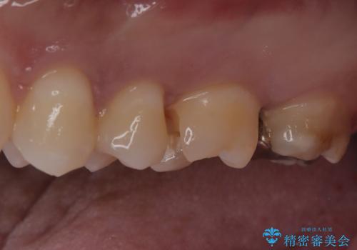 【セラミックインレー】歯科検診にて虫歯発見。の治療中