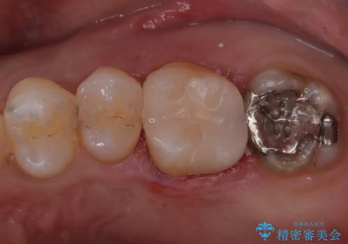 【セラミックインレー】歯科検診にて虫歯発見。