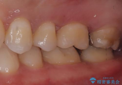 【セラミックインレー】歯科検診にて虫歯発見。の治療後