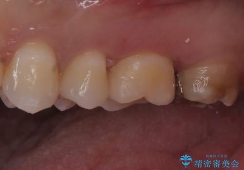 【セラミックインレー】歯科検診にて虫歯発見。の治療後