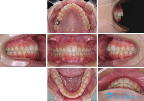 【モニター】前歯のデコボコと変色した前歯をインビザラインとオールセラミッククラウンでの治療後