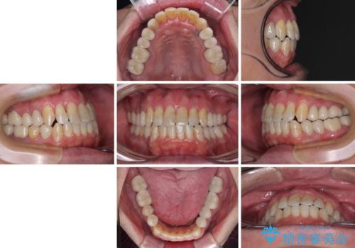 飛び出した前歯と目立つ銀歯 矯正とセラミックの総合歯科診療の治療後