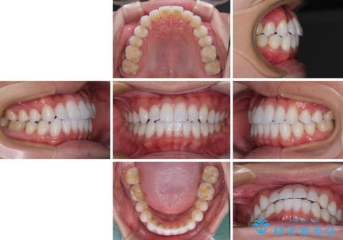 前歯のクロスバイトを改善 インビザラインによる矯正治療の治療後