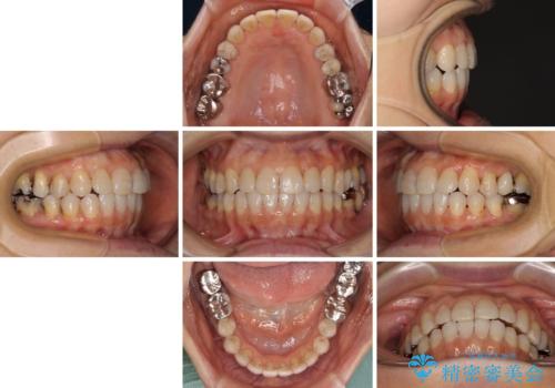 前歯の突出感と上下の隙間 インビザラインによる矯正治療の治療後