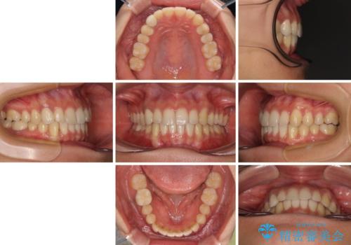 【モニター】下顎の気になる八重歯を改善 インビザラインによる矯正治療の治療後