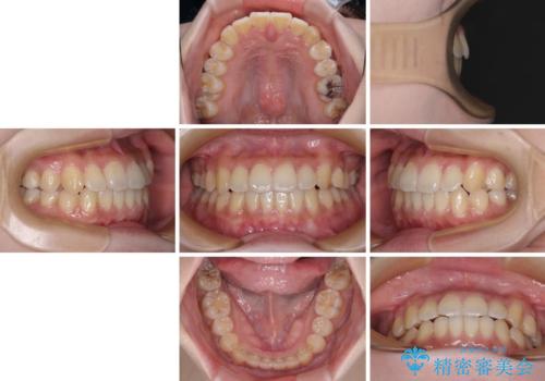 【モニター】前歯のデコボコを改善　ワイヤー矯正を併用したインビザライン矯正の治療後