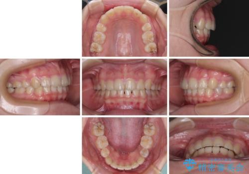 【モニター】治療途中で引っ越し ワイヤー装置を用いた抜歯矯正の治療後
