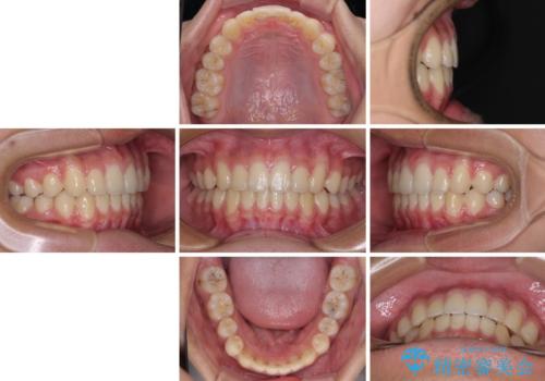 前歯の隙間とデコボコを改善 高校生のインビザライン治療の治療後