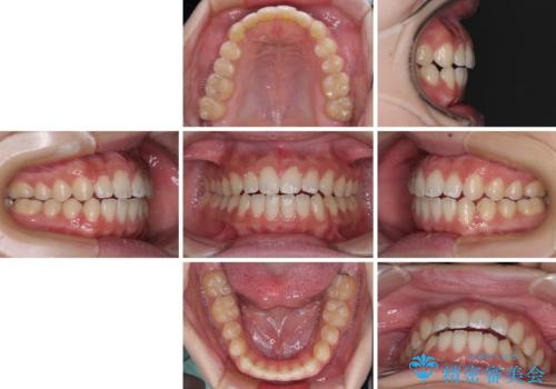 【モニター】隙間だらけの前歯を治したい インビザラインによる矯正治療の治療後