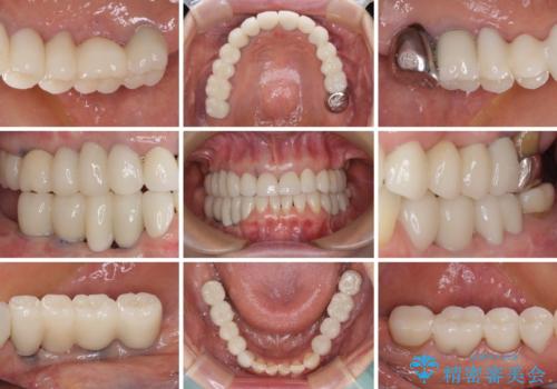 以前治療した歯がボロボロに 全顎補綴治療の治療後
