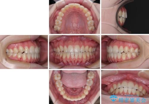 カリエール・ディスタライザーとインビザラインを用いた八重歯の改善の治療後