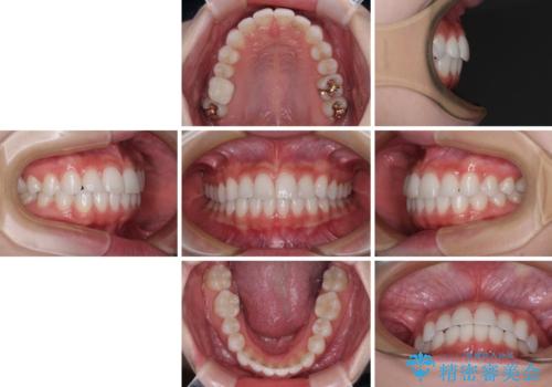 歯をきれいにしたい ワイヤー矯正治療と虫歯治療の治療後