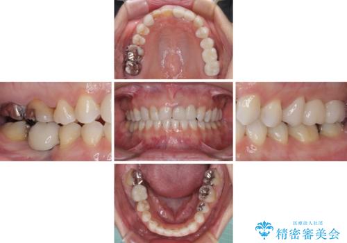 歯が全く咬みあわない 矯正と補綴の全顎治療の治療後