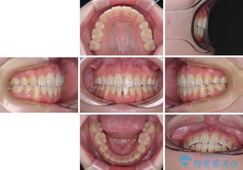 上下非接触で突出した前歯 ワイヤー装置による抜歯矯正の治療後