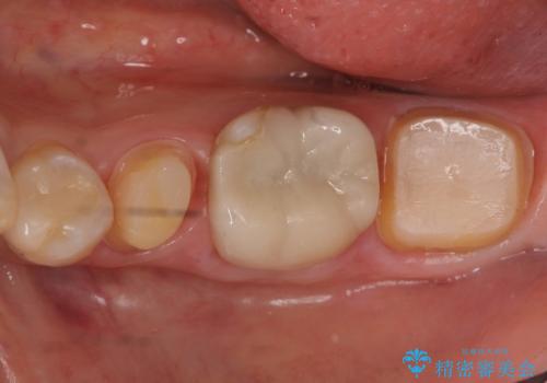 昔いれたクラウンが割れたので金属の被せ物を入れたいの治療中