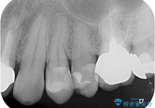 【セラミックインレー】被せ物が欠けたの治療後