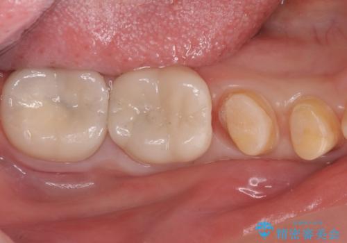 樹脂で継ぎ接ぎになった歯 セラミッククラウンでの治療の治療中