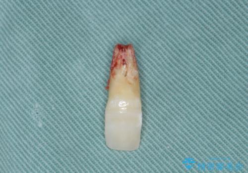 吸収し喪失した前歯、ブリッジによる審美性の回復の治療中