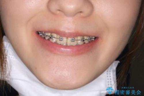 コロナ禍で矯正治療が中断:インビザラインで最終仕上げの治療前(顔貌)