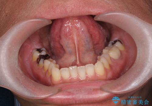 [ 舌小帯形成術 ]  滑舌を良くしたいの治療前