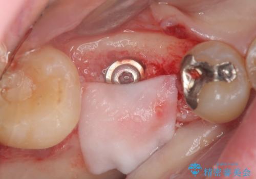 保存不可能な虫歯、インプラントによる機能回復の治療中