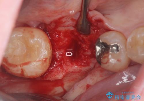 保存不可能な虫歯、インプラントによる機能回復の治療中