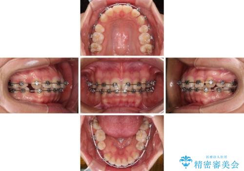 【モニター】治療途中で引っ越し ワイヤー装置を用いた抜歯矯正の治療中