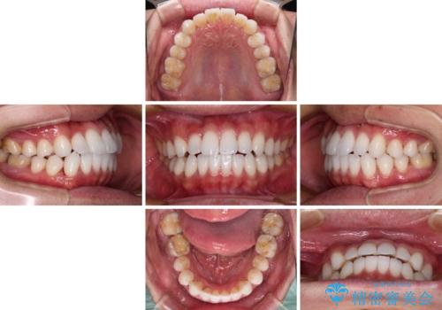 前歯のクロスバイトを改善　インビザラインによる矯正治療の治療中