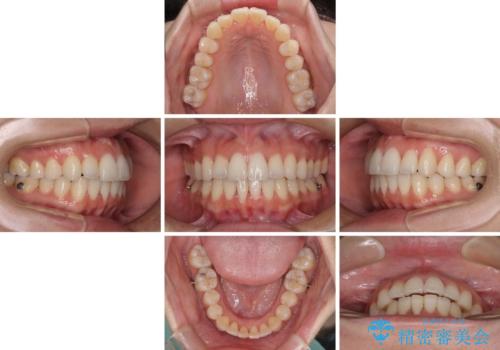 前歯のクロスバイト インビザラインによる矯正治療の治療中