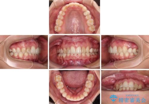 【モニター】前歯の変色とデコボコを改善　インビザラインとオールセラミックの治療中