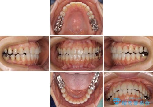 前歯の突出感と上下の隙間 インビザラインによる矯正治療の治療中