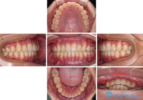 前歯の隙間とデコボコを改善 高校生のインビザライン治療の治療中