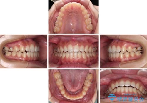 【モニター】隙間だらけの前歯を治したい インビザラインによる矯正治療の治療中
