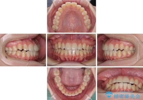 カリエール・ディスタライザーとインビザラインを用いた八重歯の改善の治療中