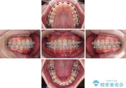歯をきれいにしたい ワイヤー矯正治療と虫歯治療の治療中