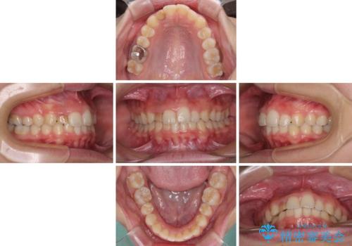 【モニター】前歯のデコボコと変色した前歯をインビザラインとオールセラミッククラウンでの治療中