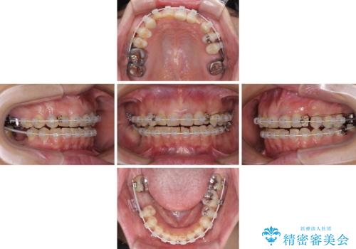 歯が全く咬みあわない 矯正と補綴の全顎治療の治療中