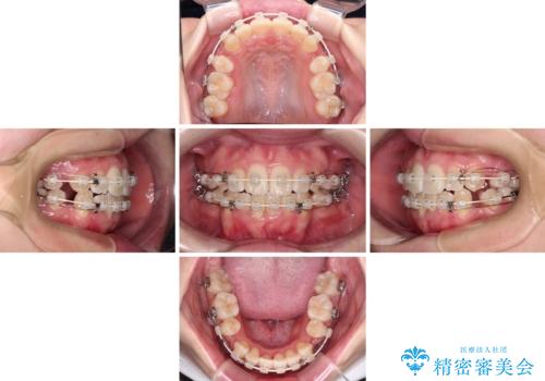 上下非接触で突出した前歯 ワイヤー装置による抜歯矯正の治療中